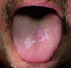 Image result for white cancer on tongue)