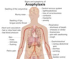 Image result for Exercise-Induced Anaphylaxis