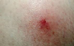 Image result for infected tick bite
