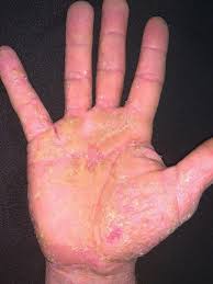 Image result for dermatitis contacta