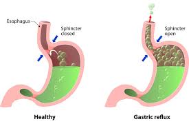An acid is a chemical substance, usually a liquid, which contains hydrogen and can react. Acid Reflux