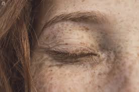 Basal cell carcinoma occurs most often on areas of the skin that are exposed to the sun, such as your head and neck. Eyelid Cancer What Is It Symptoms Causes Prevention And Treatment Top Doctors