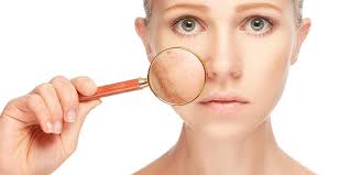 Can Sun Exposure Worsen Melasma