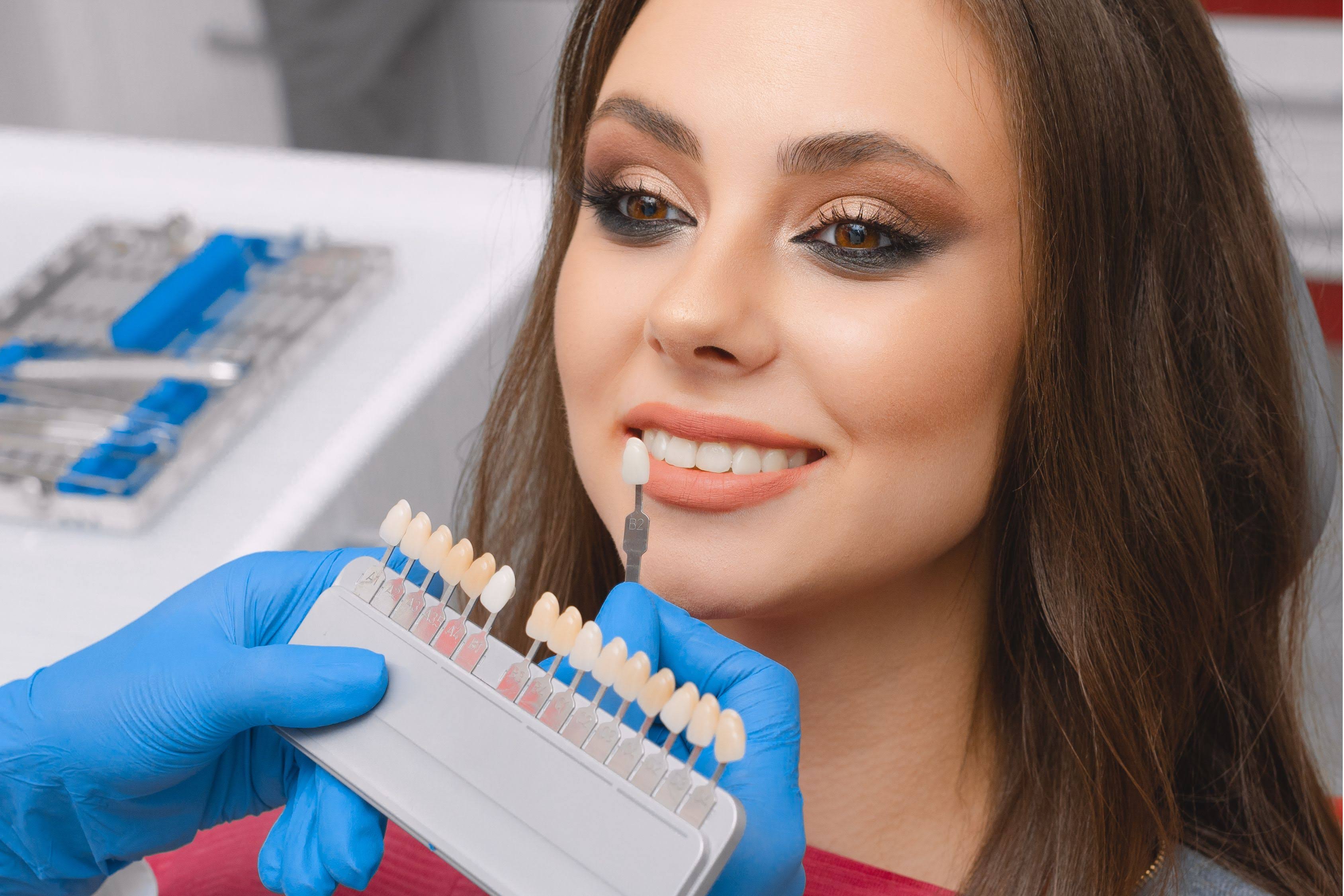 Veneers product image