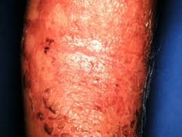 Staphylococcal Scalded Skin Syndrome Dermnet Nz