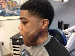 Complex multiple flap reconstruction in a rare recurrent metastatic  osteosarcoma of the mandible