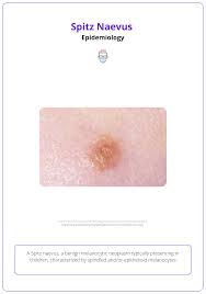 Image result for Spitz Nevus
