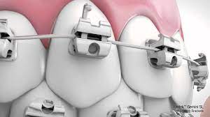 3m Unitek Gemini Sl Self Ligating System Youtube