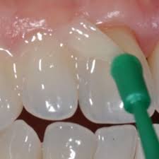 The fluoride varnish sticks to the teeth until brushed away the next day, however, the benefits of the fluoride will last for several months. Fluoride Varnish Application Education For Dental