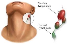 Symptoms Of Lupus Swollen Lymph Nodes Lymph Nodes Lymph Glands