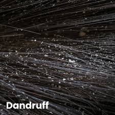 Image result for lice vs dandruff