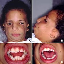 Le syndrome de treacher collins (stc) ou syndrome de franceschetti (sf) est une maladie génique rare. Clinical And Imaging Correlations Of Treacher Collins Syndrome Report Of Two Cases Oral Surgery Oral Medicine Oral Pathology Oral Radiology And Endodontics