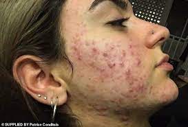 This is how a laser hair removal procedure goes on in iran. Student Who Developed Cystic Acne After Laser Hair Removal Reveals How She Healed Her Scars Daily Mail Online
