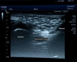 Image result for Pudendal Block