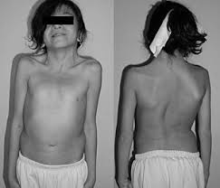 Image result for Webbed Neck