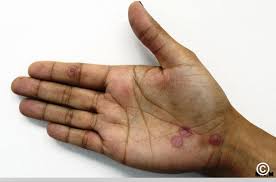 Image result for Erythema Multiforme Major