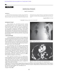 Image result for Broncholithiasis
