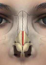 Skin grafting or skin transplant is a medical procedure of transplanting skin from one part of the body to another and is carried out with the intention of promotinghealing. Rhinoplasty Orange County Deviated Nose Newport Beach Nose Surgery Cruise Plastic Surgery