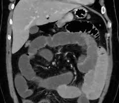 Image result for Adynamic Ileus