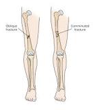 Image result for icd 10 code for right distal femoral shaft fracture