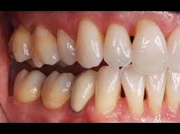 What Are Those Black Triangles Between The Teeth Youtube Teeth Teeth Health Teeth Shape