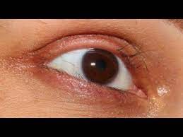 As we age, eyelash follicles (the openings in the skin through which the lash grows) can slow or stop producing new lashes altogether. Stop Eyelashes From Falling Out Natural Remedy Youtube