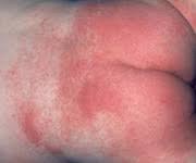 Image result for newborn diaper rash