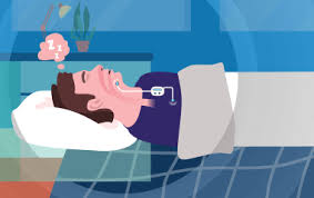 Image result for Obstructive Sleep Apnea