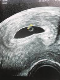 Ab wann diese tätigkeit im ultraschall sichtbar ist, variiert etwas. Us 6 Woche Kein Herzschlag Schwangerschaftsgruppe Seite 2 Babycenter