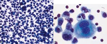 Like other types of mesothelioma, this particular form of the disease gets its name because of where it is formed — in. Malignant And Borderline Mesothelial Tumors Of The Pleura Thoracic Key