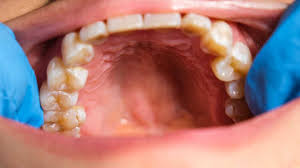 Image result for Physical injury red spots roof of mouth