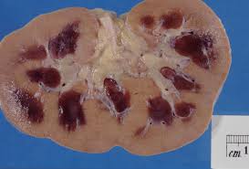 Genitourinary history of polyuria (excessive urination) due to diabetes, renal disease, unknown cause, etc. Kidney Disease Wikipedia