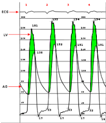 Aortic Stenosis Wikipedia