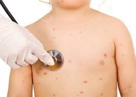 هن أعراض وعلاج وأسباب الجدري المائي بعد إغلاق مدرسة في كفر الشيخ بسببه