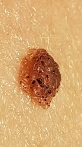Verandertes Muttermal Hautkrebs Arzt Hautarzt Dermatologie