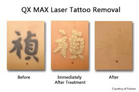 So to do you all a solid, i put together a list of. Laser Tattoo Removal Nyc Garden City Prasad Cosmetic Surgery
