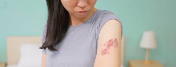 Image result for shingles