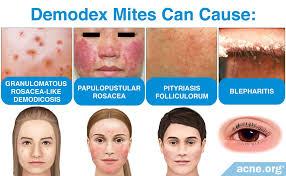 Image result for demodex rosacea