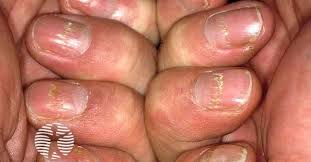 Image result for Beau lines feet