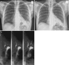 Uk instillation to the intrapleural space should be considered early before initiating surgical intervention. Empyema Thoracis New Insights Into An Old Disease European Respiratory Society