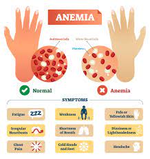 Iron-Deficiency Anemia -HealthScope