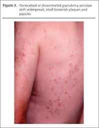 Granuloma annulare is a harmless skin condition that causes rashes and bumps, usually on your hands or feet. Necrobiosis Lipoidica And Granuloma Annulare Part 2 Granuloma Annulare George British Journal Of Diabetes