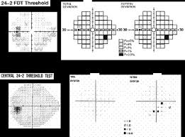 Frequency Doubling Technology Fdt Perimetry