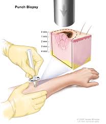 Squamous cell carcinoma treatment has a much higher success rate than other forms of cancer, as long as the tumor has not metastasized to other areas of the body. Skin Cancer Treatment Pdq Patient Version National Cancer Institute