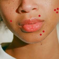 How to get rid of a lip pimple fast. How To Safely Treat Your Postpartum Acne Self