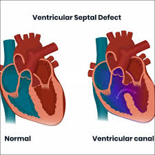 Image result for Ventricular Septal Defect