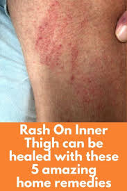 The itch may be felt in one area or even all over the body. Pin On Household Ideas
