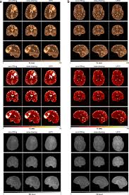 Profilo di sebastián pérez (30) ➤ cd universidad católica ➤ scheda, valore di mercato, statistiche, mercato, carriera e tanto altro. Accelerated 3d Whole Brain T1 T2 And Proton Density Mapping Feasibility For Clinical Glioma Mr Imaging Springerlink