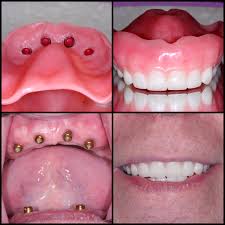 Implant Dentures Snap In Place Denture Implants Dental Dental Implants
