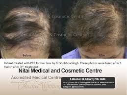 Recognised leading australian hair loss surgery clinic. Hair Loss Treatment Melbourne Glenroy Nitai Medical Cosmetic Centre